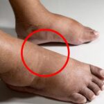 Podiatrist wa.rns anyone with discoloured toenails should see doctor immediately